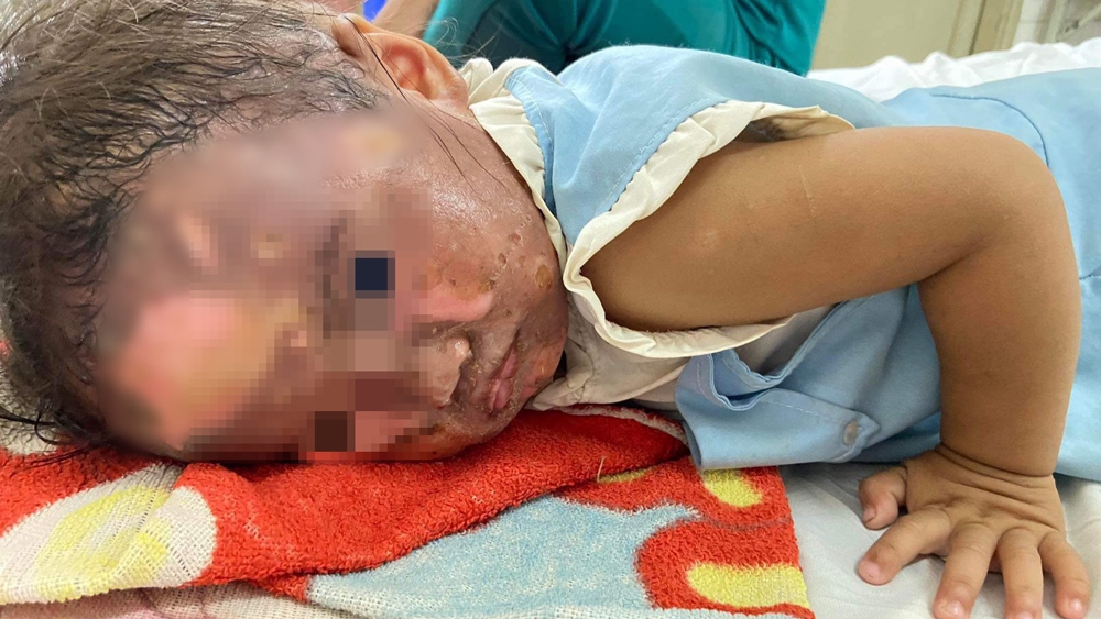 Bé gái 2 tuổi ở Bình Dương ngã úp mặt vào tô mì bỏng nặng